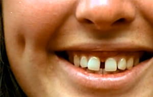 Diastema: ¿el rasgo que define a las ninfómanas?