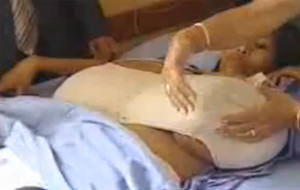El caso de Julia y su gigantomastia bilateral