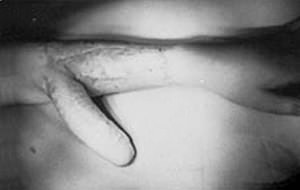 Transplante de pene